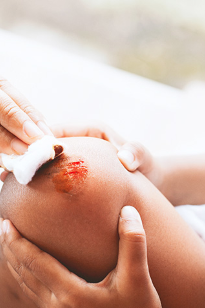 First Aid Tips: Treating Minor Injuries at Home